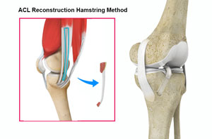 Anterior Cruciate Ligament Tears