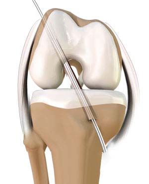 ACL RECONSTRUCTION