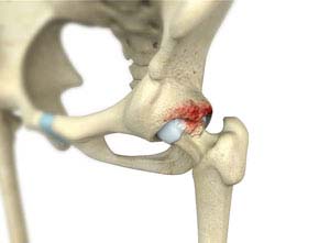 FEMORO ACETABULAR IMPINGEMENT (FAI)