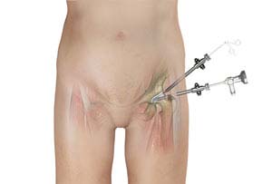 HIP ARTHROSCOPY