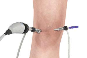 KNEE ARTHROSCOPY
