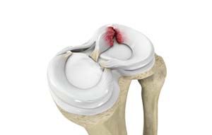 MENISCUS TEAR