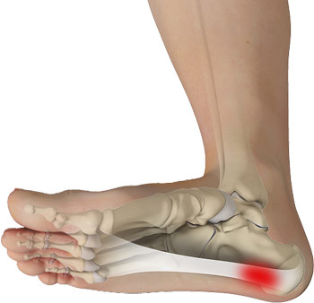 PLANTAR FASCIITIS AND HEEL SPURS