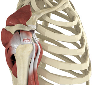 ROTATOR CUFF TEAR