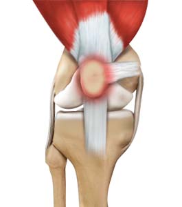 RUNNER’S KNEE