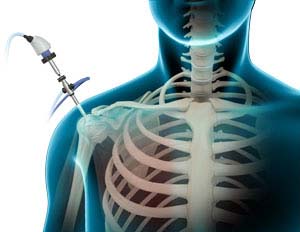SHOULDER ARTHROSCOPY