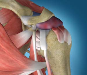 SHOULDER IMPINGEMENT SYNDROME