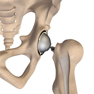 TOTAL HIP REPLACEMENT