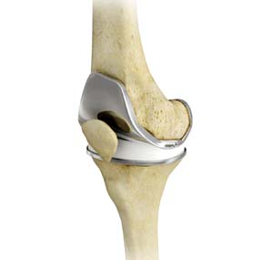 TOTAL KNEE JOINT REPLACEMENT